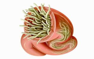 pinworm férgek kezelése a condyloma megnyilvánulása férfiaknál