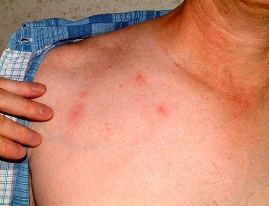 a bőr alatti paraziták tünetei
