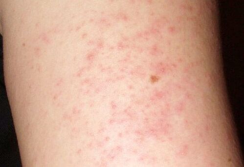 Viszkető bőrkiütések - a májban lévő férgek jelenlétének tünete