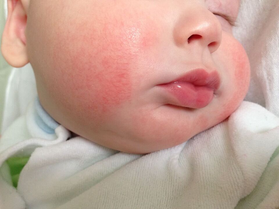 A férgek jele egy gyermeknél az allergiás csalánkiütés